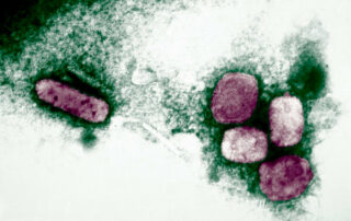 viruela del mono en ecuador